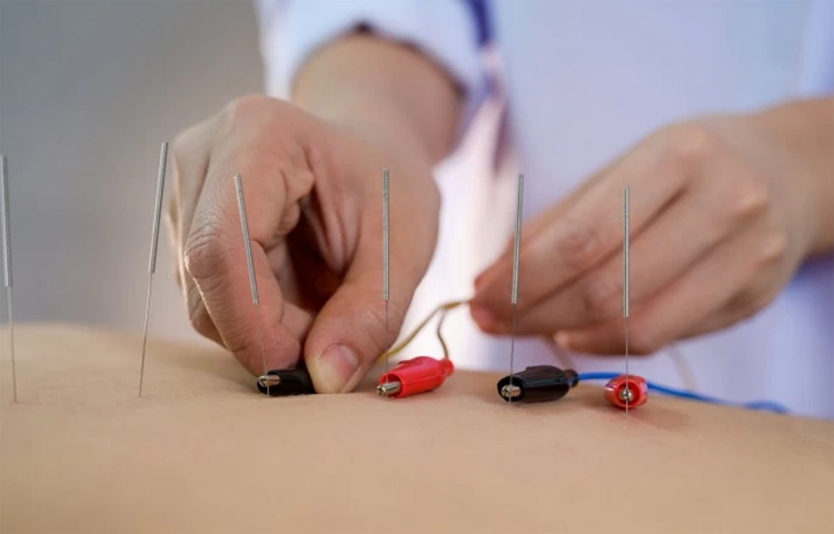 Điện châm điều trị bệnh trĩ ((Hạ trĩ) Trĩ độ 1; Trĩ độ 2; Trĩ độ 3)